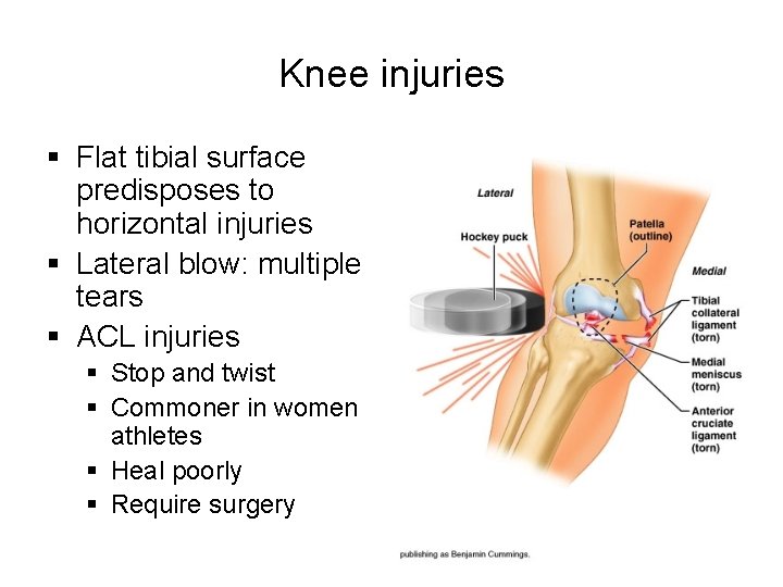 Knee injuries § Flat tibial surface predisposes to horizontal injuries § Lateral blow: multiple