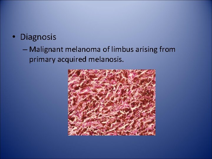  • Diagnosis – Malignant melanoma of limbus arising from primary acquired melanosis. 