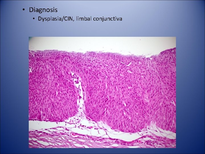 • Diagnosis • Dysplasia/CIN, limbal conjunctiva 