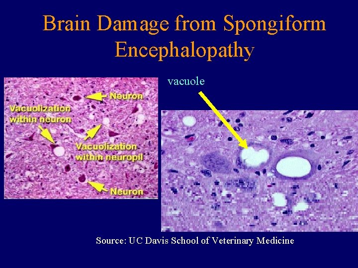 Brain Damage from Spongiform Encephalopathy vacuole Source: UC Davis School of Veterinary Medicine 
