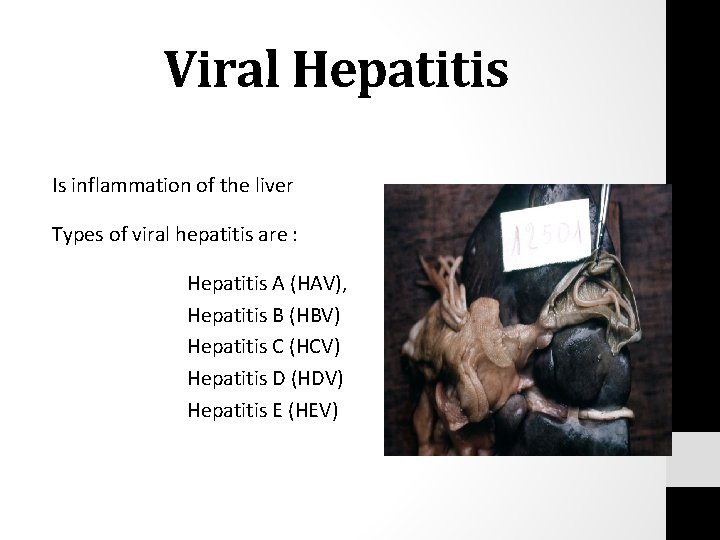 Viral Hepatitis Is inflammation of the liver Types of viral hepatitis are : Hepatitis