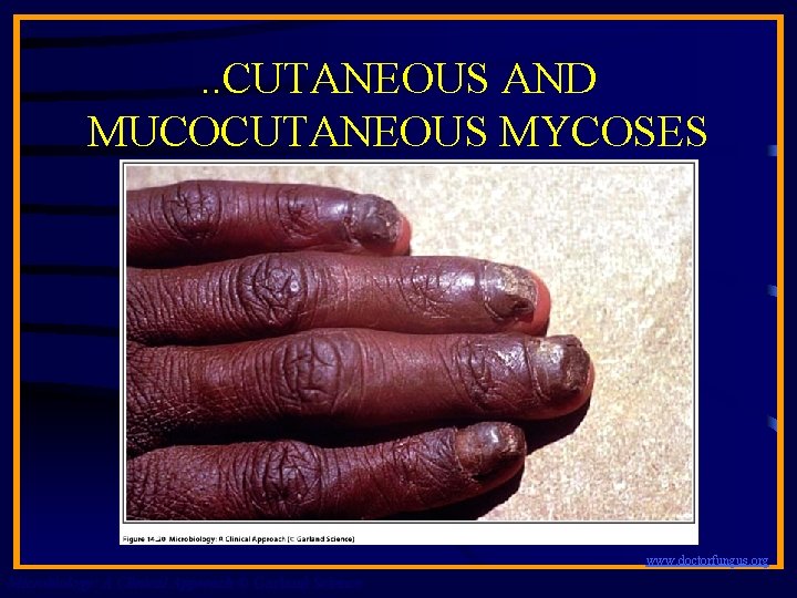 . . CUTANEOUS AND MUCOCUTANEOUS MYCOSES www. doctorfungus. org Microbiology: A Clinical Approach ©