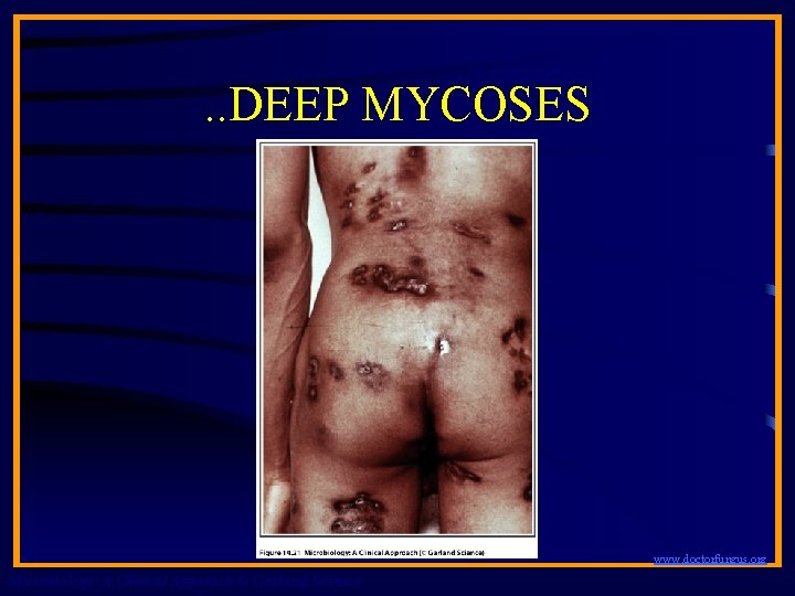 . . DEEP MYCOSES www. doctorfungus. org Microbiology: A Clinical Approach © Garland Science