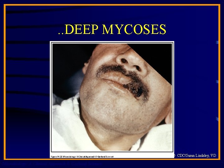 . . DEEP MYCOSES © CDC/Susan Lindsley, VD Microbiology: A Clinical Approach © Garland