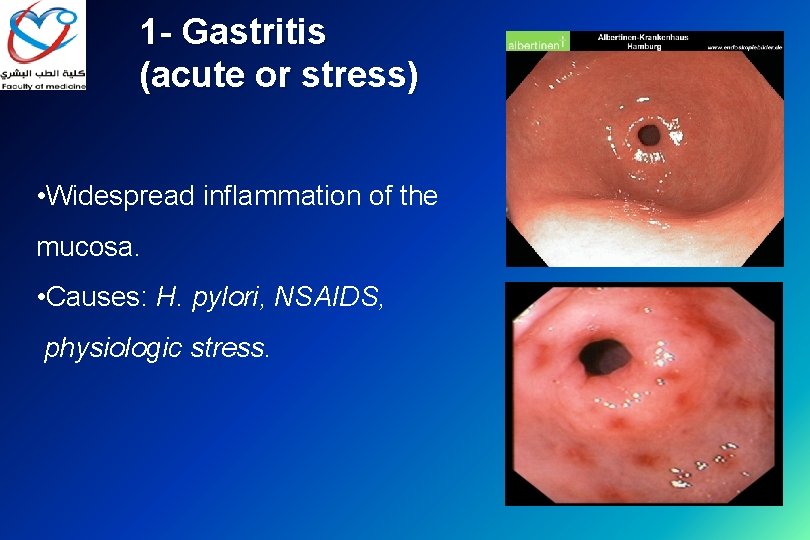 1 - Gastritis (acute or stress) • Widespread inflammation of the mucosa. • Causes: