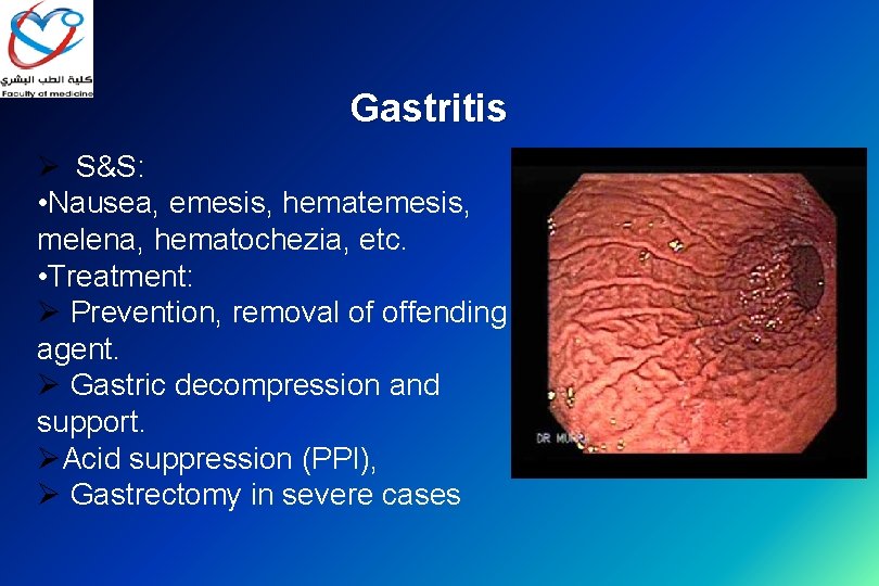 Gastritis Ø S&S: • Nausea, emesis, hematemesis, melena, hematochezia, etc. • Treatment: Ø Prevention,