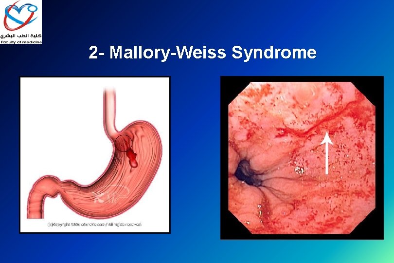 2 - Mallory-Weiss Syndrome 