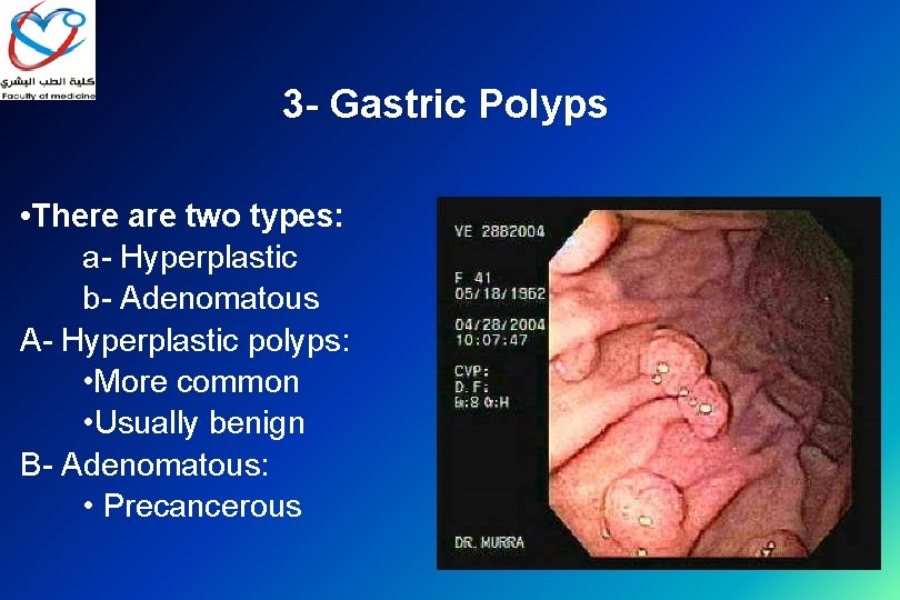 3 - Gastric Polyps • There are two types: a- Hyperplastic b- Adenomatous A-