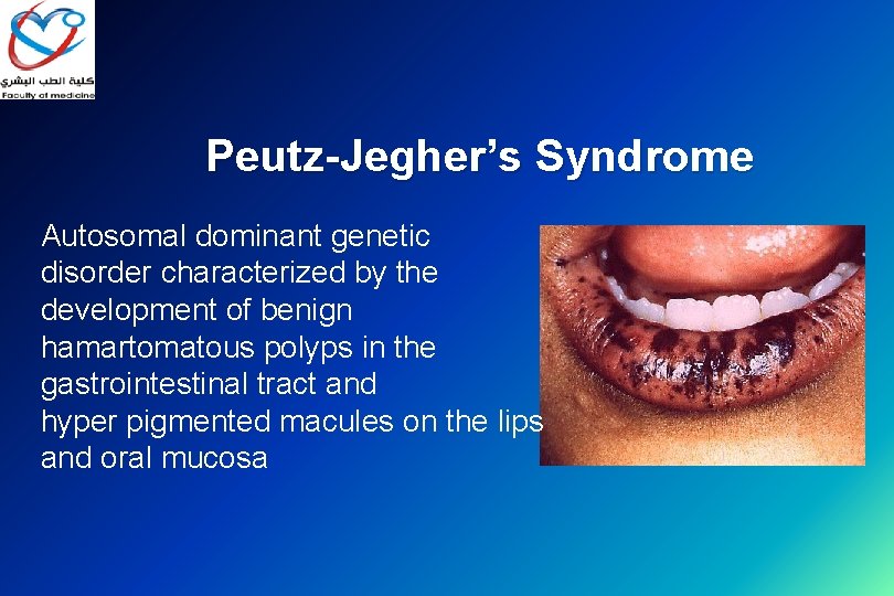 Peutz-Jegher’s Syndrome Autosomal dominant genetic disorder characterized by the development of benign hamartomatous polyps