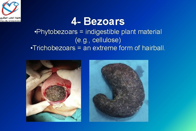 4 - Bezoars • Phytobezoars = indigestible plant material (e. g. , cellulose) •