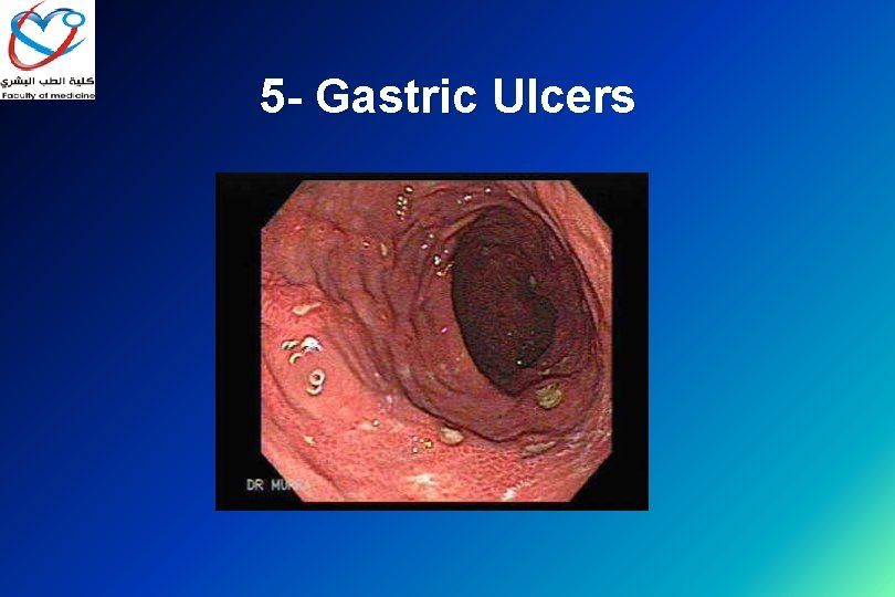 5 - Gastric Ulcers 