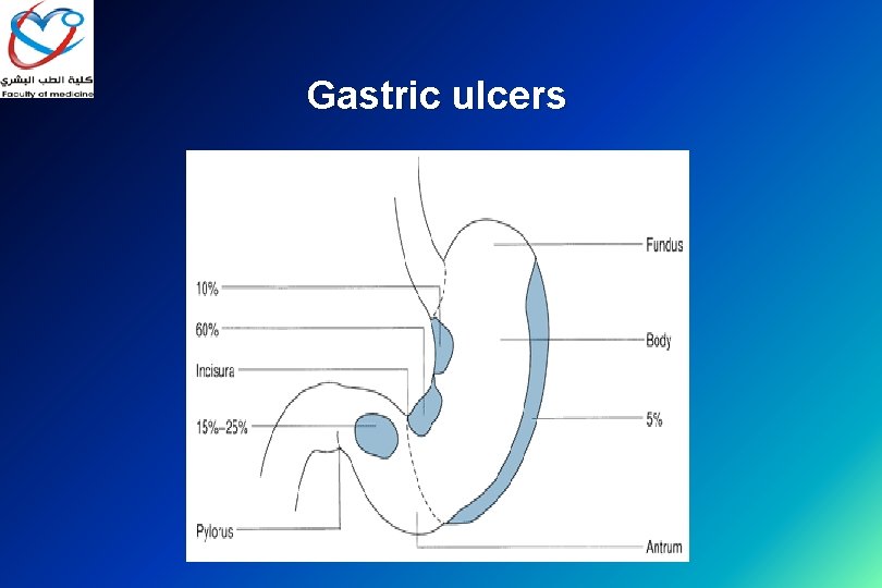 Gastric ulcers 