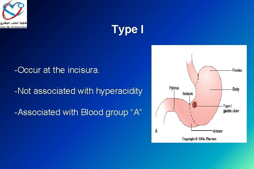 Type I -Occur at the incisura. -Not associated with hyperacidity -Associated with Blood group