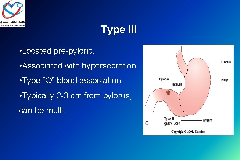 Type III • Located pre-pyloric. • Associated with hypersecretion. • Type “O” blood association.
