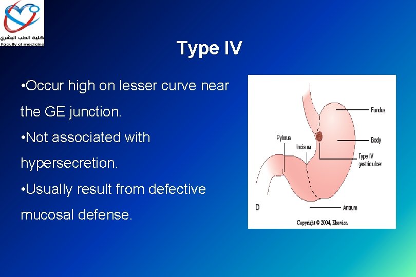 Type IV • Occur high on lesser curve near the GE junction. • Not