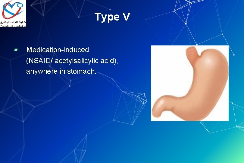 Type V ▰ Medication-induced (NSAID/ acetylsalicylic acid), anywhere in stomach. 