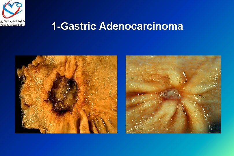 1 -Gastric Adenocarcinoma 