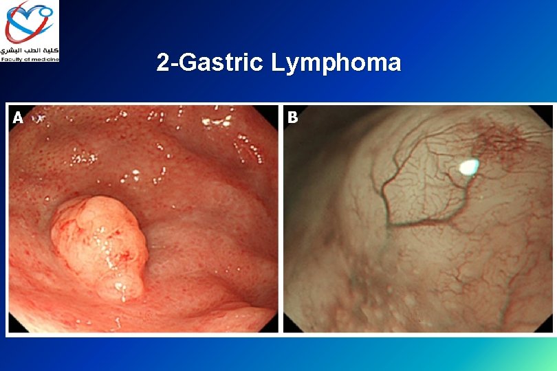 2 -Gastric Lymphoma 