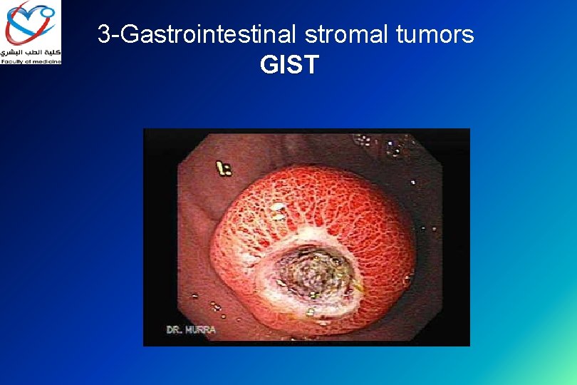 3 -Gastrointestinal stromal tumors GIST 