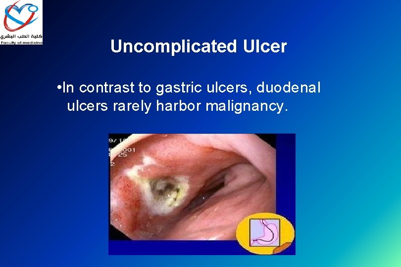 Uncomplicated Ulcer • In contrast to gastric ulcers, duodenal ulcers rarely harbor malignancy. 