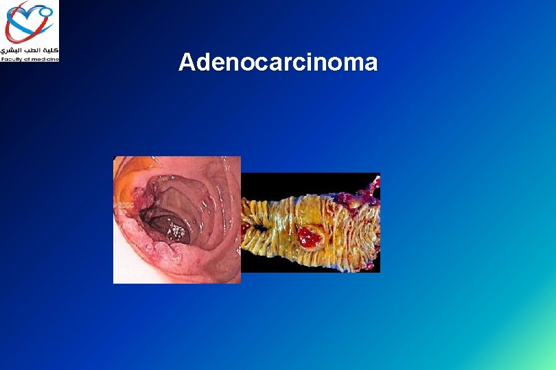 Adenocarcinoma 