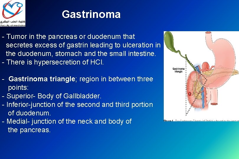 Gastrinoma - Tumor in the pancreas or duodenum that secretes excess of gastrin leading