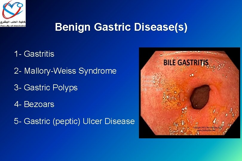 Benign Gastric Disease(s) 1 - Gastritis 2 - Mallory-Weiss Syndrome 3 - Gastric Polyps