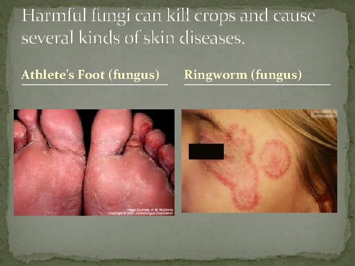 Harmful fungi can kill crops and cause several kinds of skin diseases. Athlete's Foot
