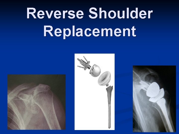 Reverse Shoulder Replacement 