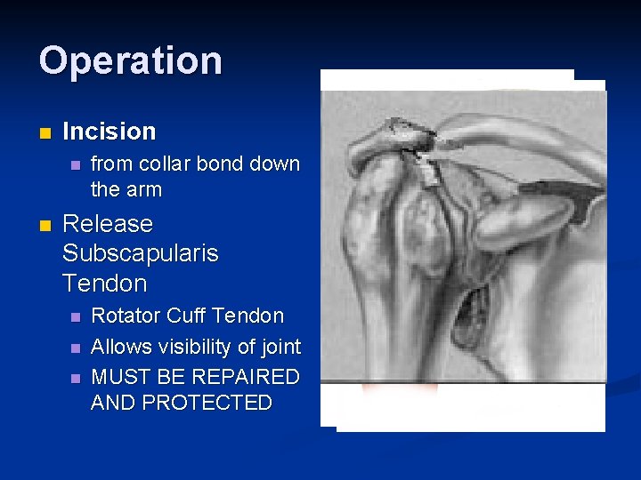 Operation n Incision n n from collar bond down the arm Release Subscapularis Tendon