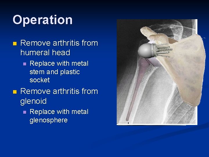 Operation n Remove arthritis from humeral head n n Replace with metal stem and
