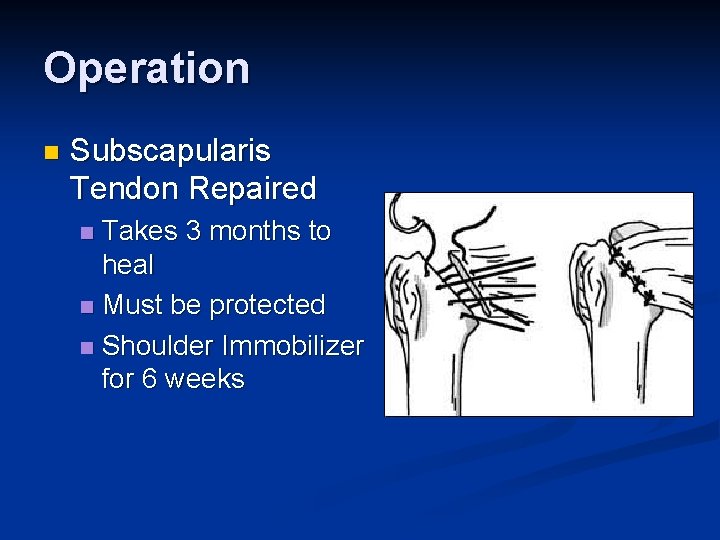 Operation n Subscapularis Tendon Repaired Takes 3 months to heal n Must be protected