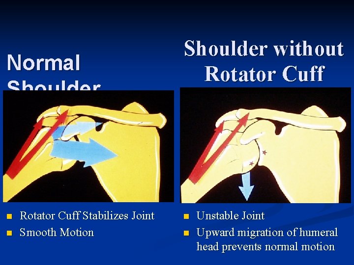 Normal Shoulder n n Rotator Cuff Stabilizes Joint Smooth Motion Shoulder without Rotator Cuff