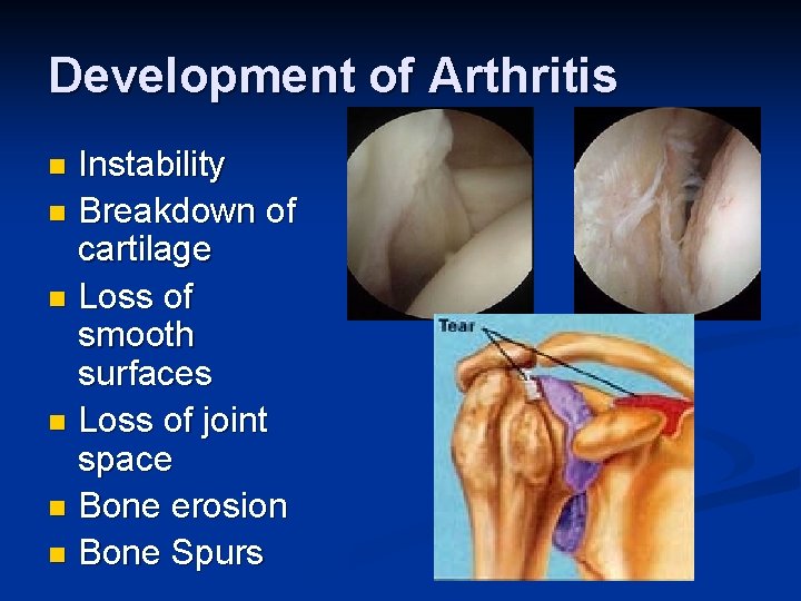Development of Arthritis Instability n Breakdown of cartilage n Loss of smooth surfaces n