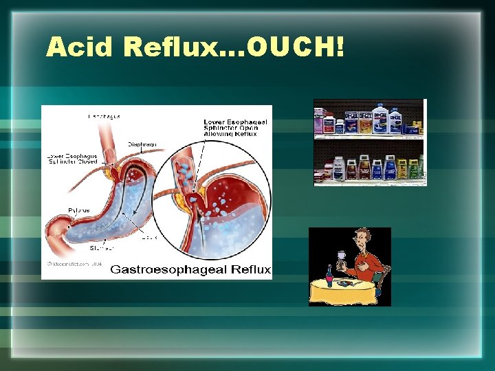 Acid Reflux…OUCH! 