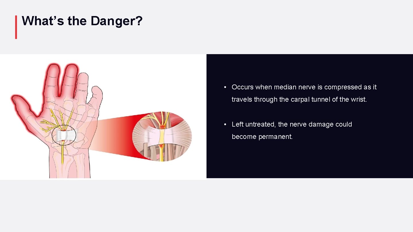 What’s the Danger? • Occurs when median nerve is compressed as it travels through