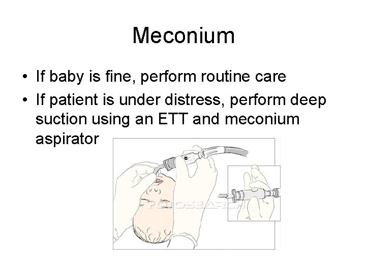 Meconium • If baby is fine, perform routine care • If patient is under