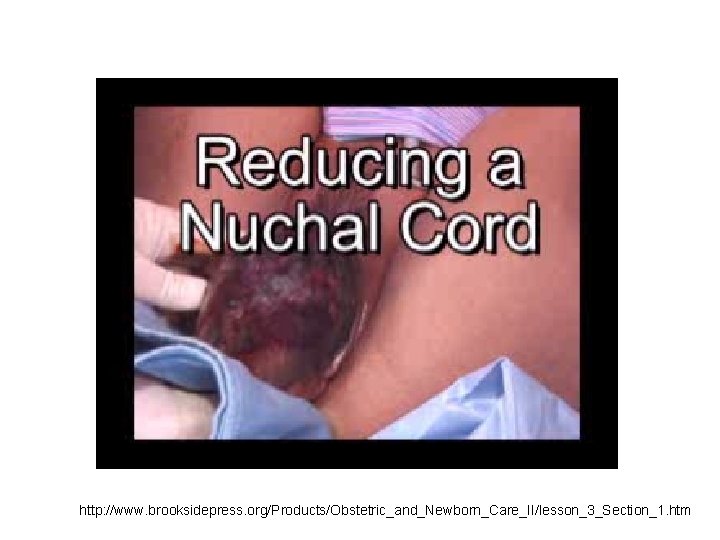 http: //www. brooksidepress. org/Products/Obstetric_and_Newborn_Care_II/lesson_3_Section_1. htm 