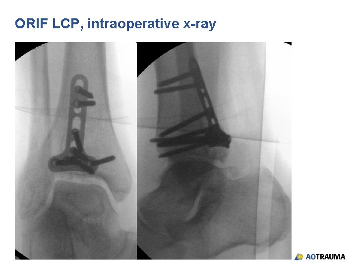 Articular fractures of the tibia moderated interactive session