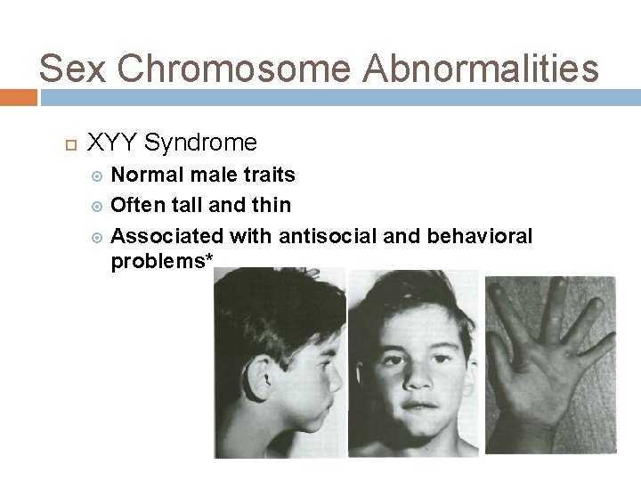 Sex Chromosome Abnormalities XYY Syndrome Normal male traits Often tall and thin Associated with
