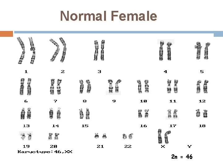 Normal Female 2 n = 46 35 