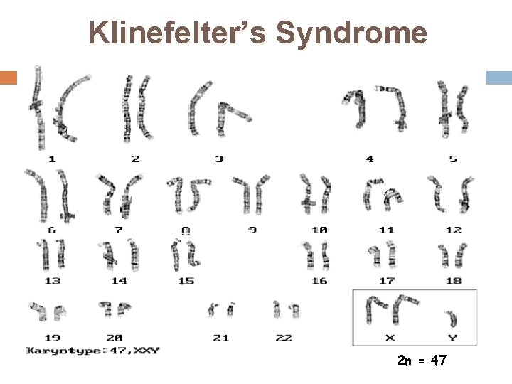 Klinefelter’s Syndrome 2 n = 47 38 