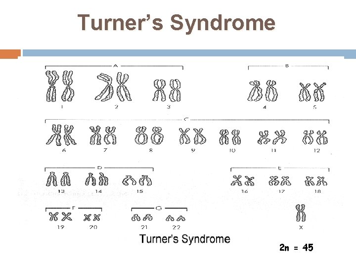 Turner’s Syndrome 2 n = 45 39 
