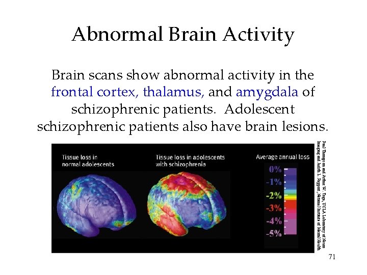 Abnormal Brain Activity Brain scans show abnormal activity in the frontal cortex, thalamus, and