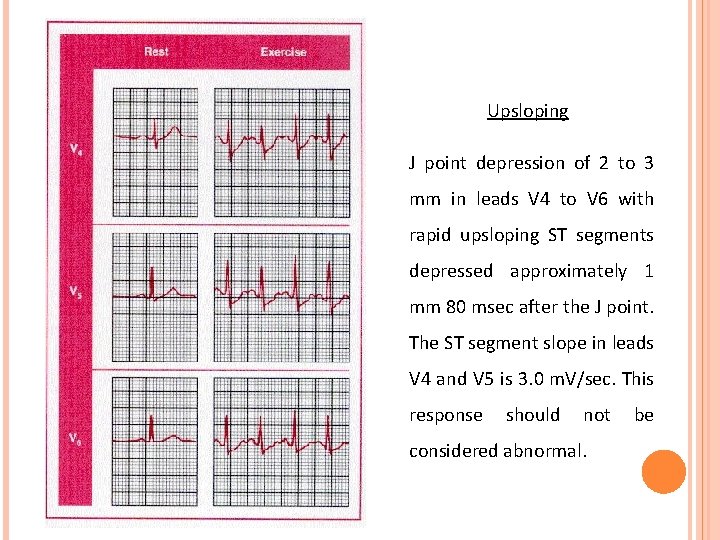 Upsloping J point depression of 2 to 3 mm in leads V 4 to