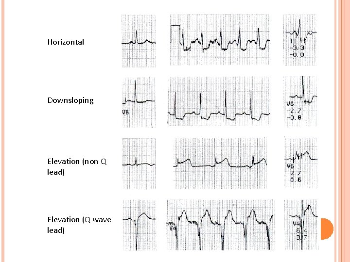 Horizontal Downsloping Elevation (non Q lead) Elevation (Q wave lead) 