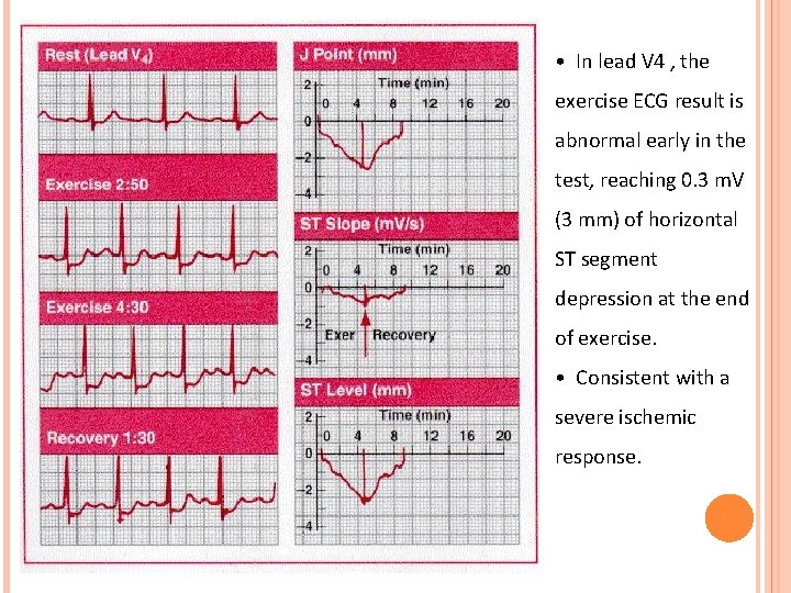  • In lead V 4 , the exercise ECG result is abnormal early