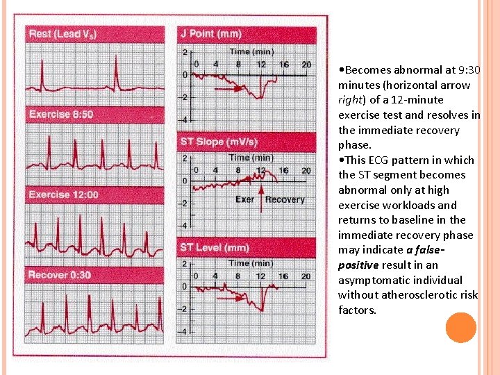  • Becomes abnormal at 9: 30 minutes (horizontal arrow right) of a 12