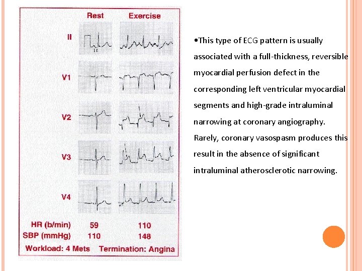  • This type of ECG pattern is usually associated with a full-thickness, reversible