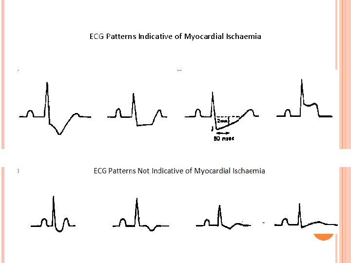 ECG Patterns Indicative of Myocardial Ischaemia ECG Patterns Not Indicative of Myocardial Ischaemia 